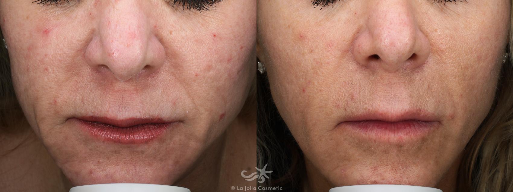 Before & After Sculptra® Result 929 Front View in San Diego, Carlsbad, CA