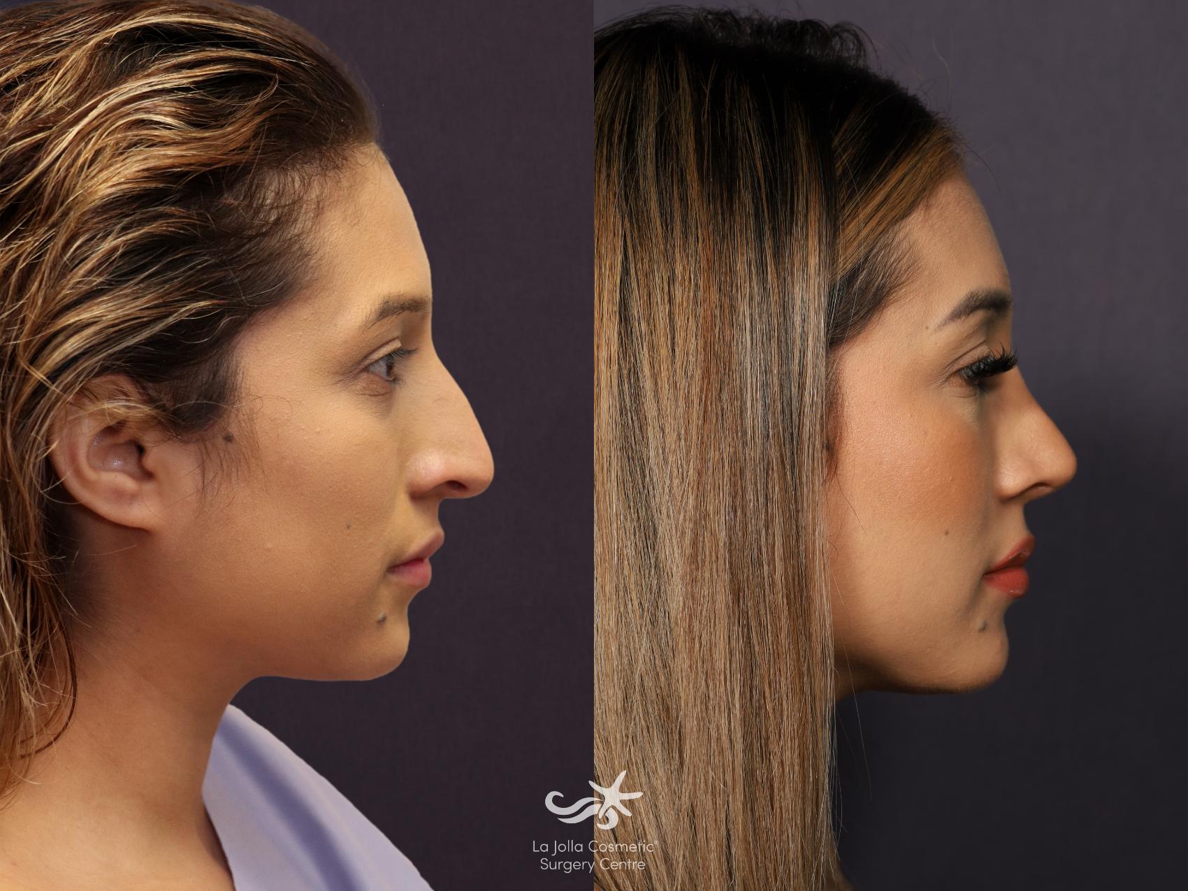 Before & After Septorhinoplasty Result 795 Right Side View in San Diego, CA