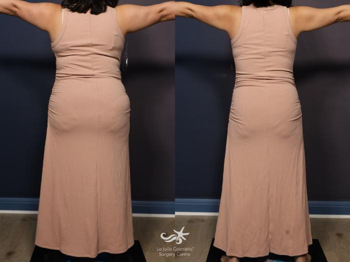 lipo c skinny shot reviews Weight Loss Program Before and After Pictures Result 1252 | San Diego, CA Lipo-C