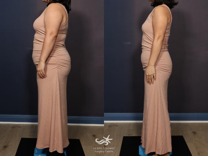 Skinny Shot Weight Loss Program Before and After Pictures Result 1252 | San  Diego, CA | La Jolla Cosmetic Surgery Centre