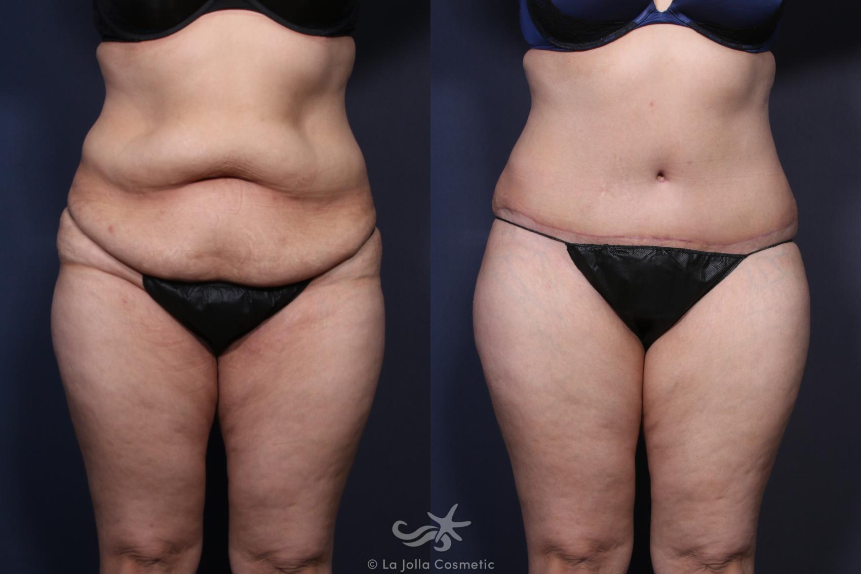 Before & After Tummy Tuck Result 123 Front View in San Diego, CA