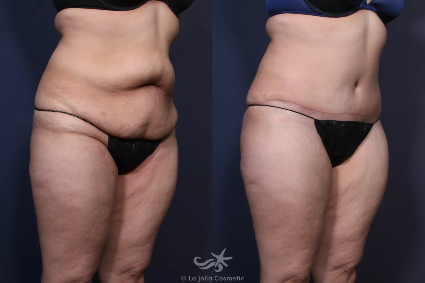 Before & After Tummy Tuck Result 123 Right Oblique View in San Diego, CA