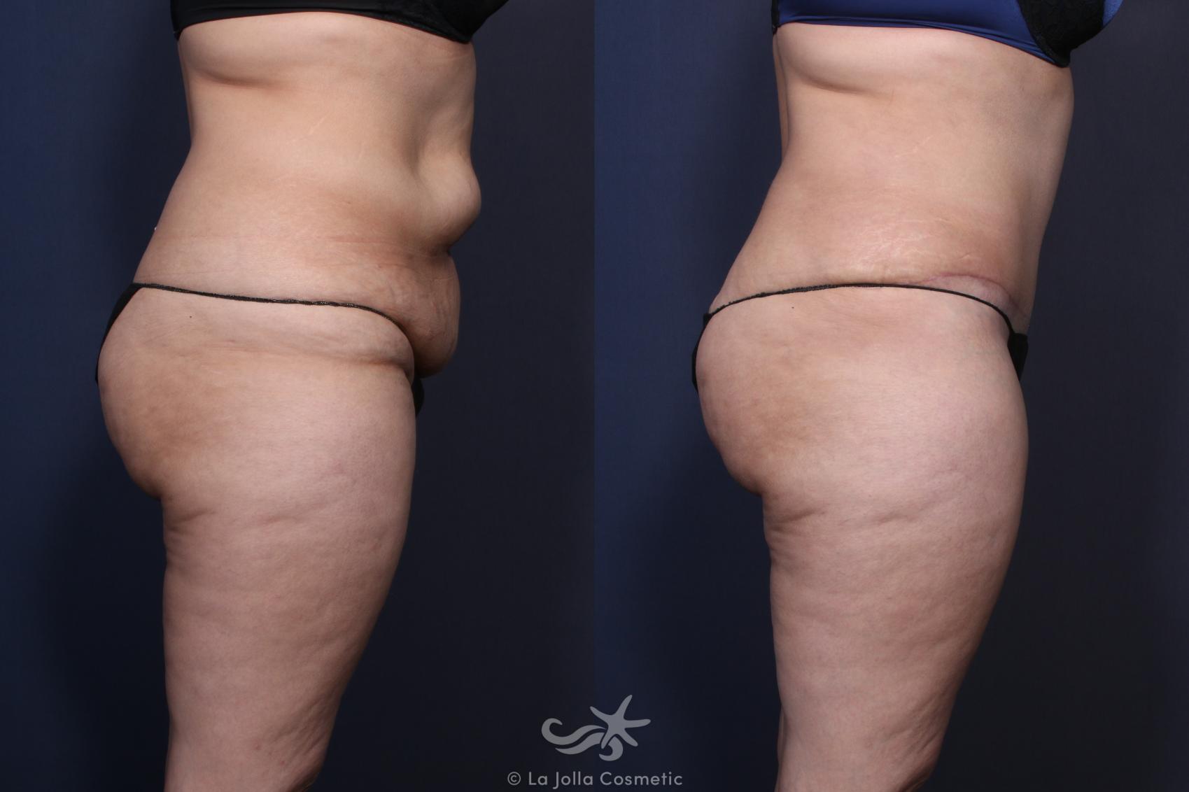 Before & After Tummy Tuck Result 123 Right Side View in San Diego, CA
