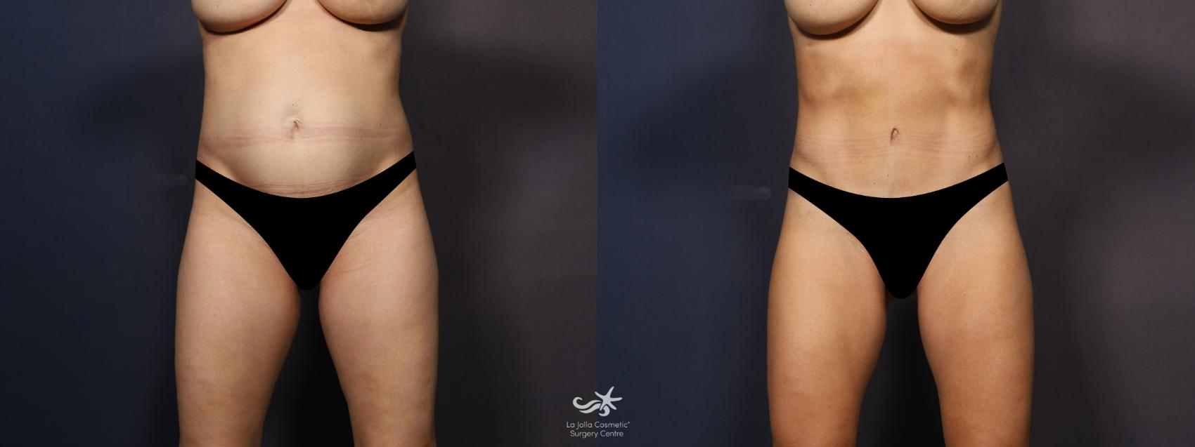 Before & After Tummy Tuck Result 1239 Front View in San Diego, CA