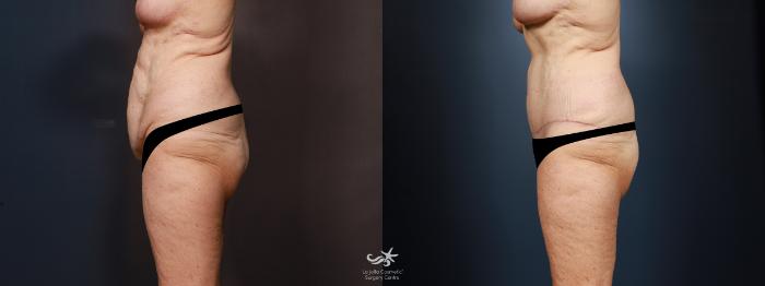 quando assumere acetil l carnitina C-Section Scar Revision Before and After Pictures Case 600 | Waterloo,  Ontario