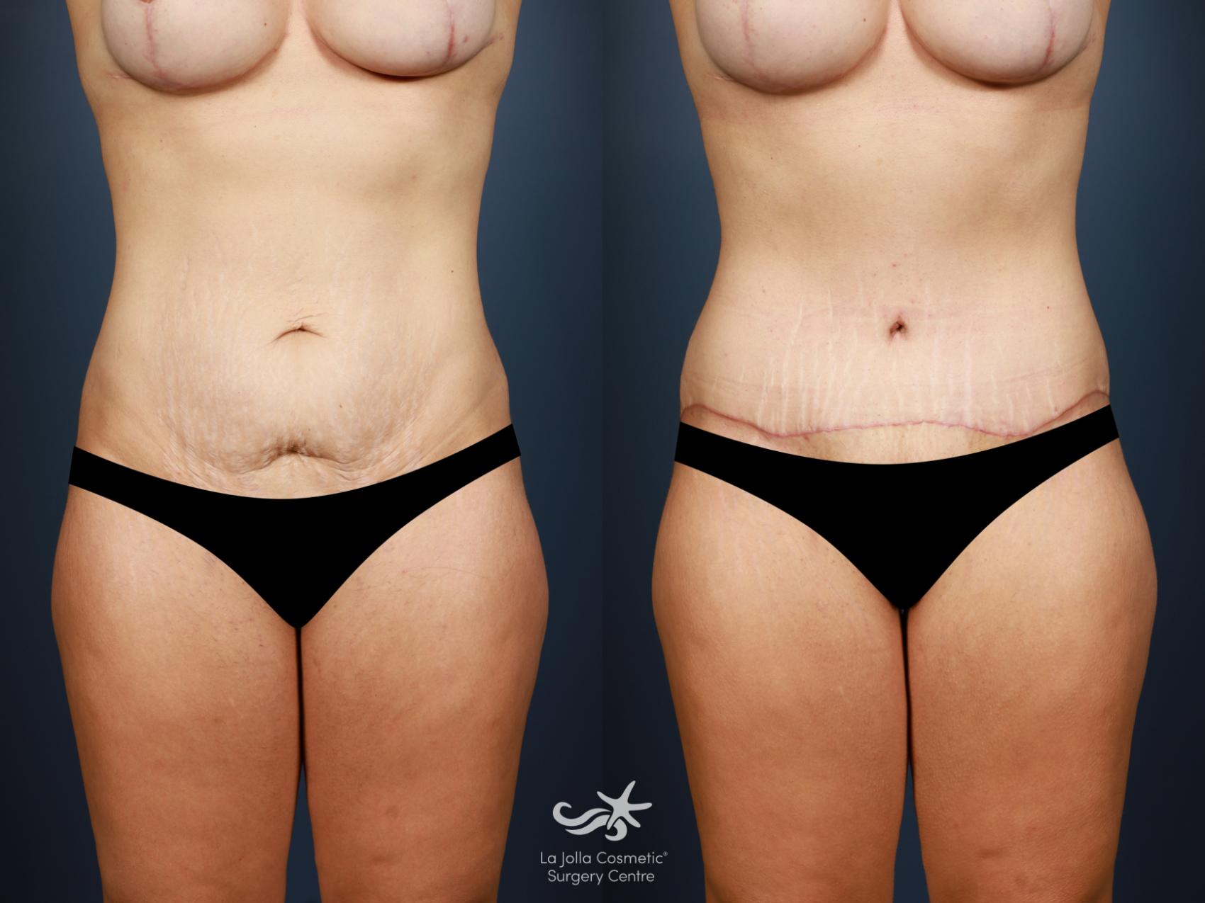 Before & After Tummy Tuck Result 1331 Front View in San Diego, CA
