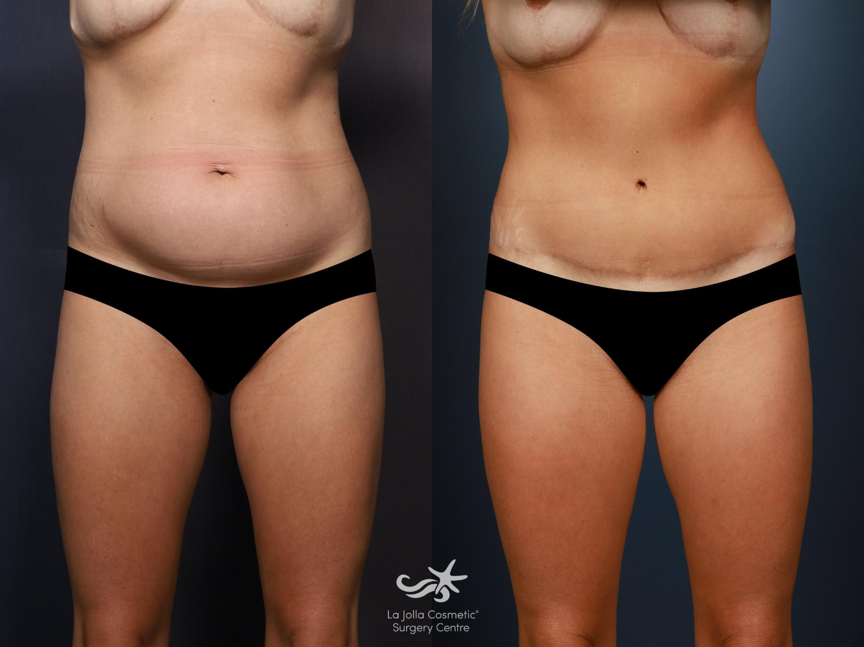 Before & After Tummy Tuck Result 1411 Front View in San Diego, CA