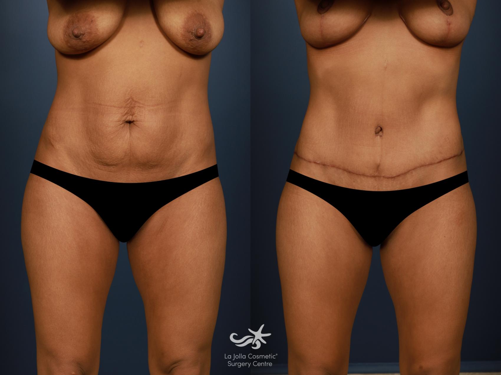 Before & After Tummy Tuck Result 1417 Front View in San Diego, CA
