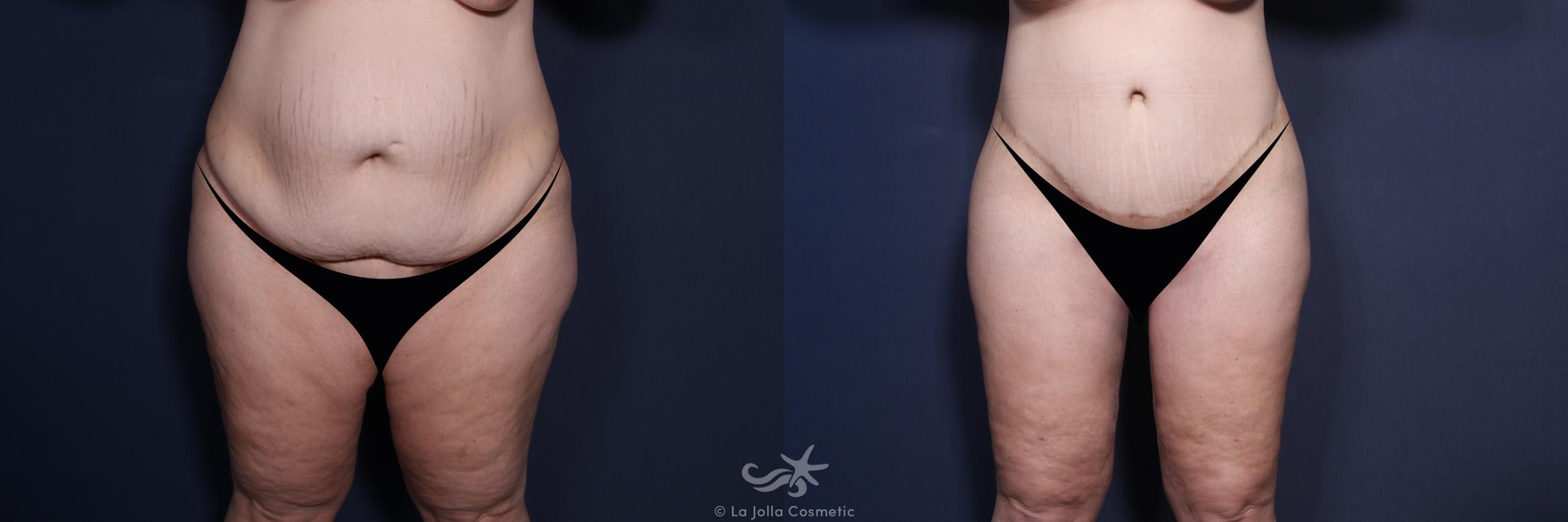 Before & After Tummy Tuck Result 171 Front View in San Diego, CA