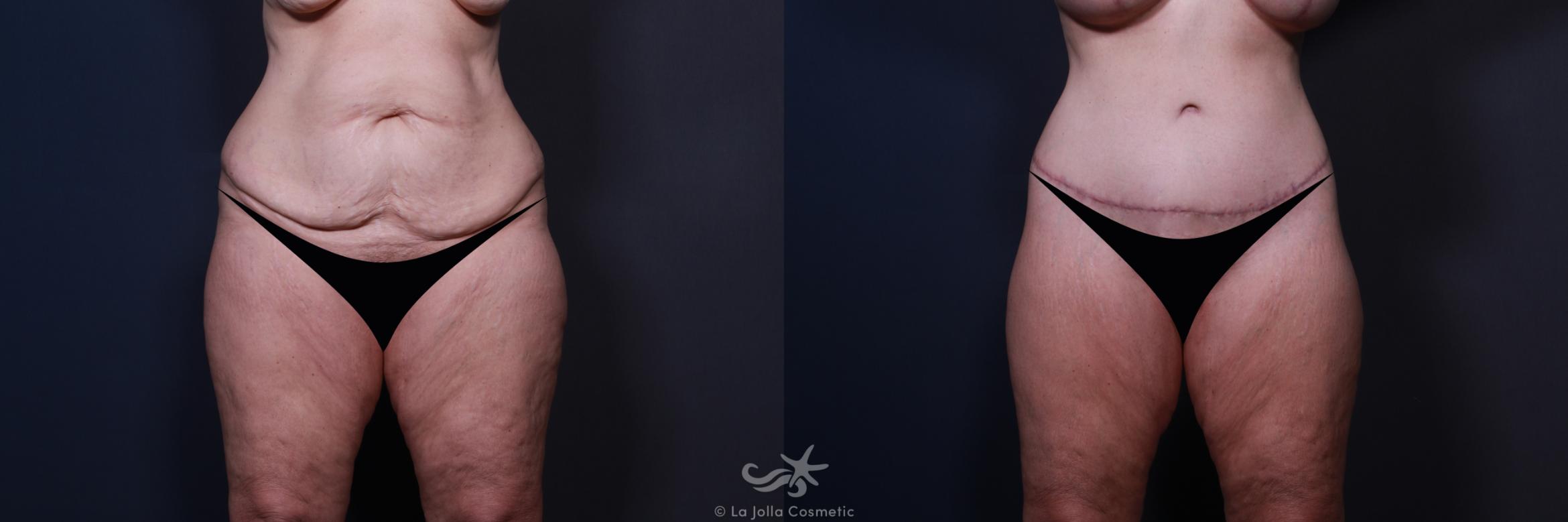 Before & After Tummy Tuck Result 184 Front View in San Diego, CA