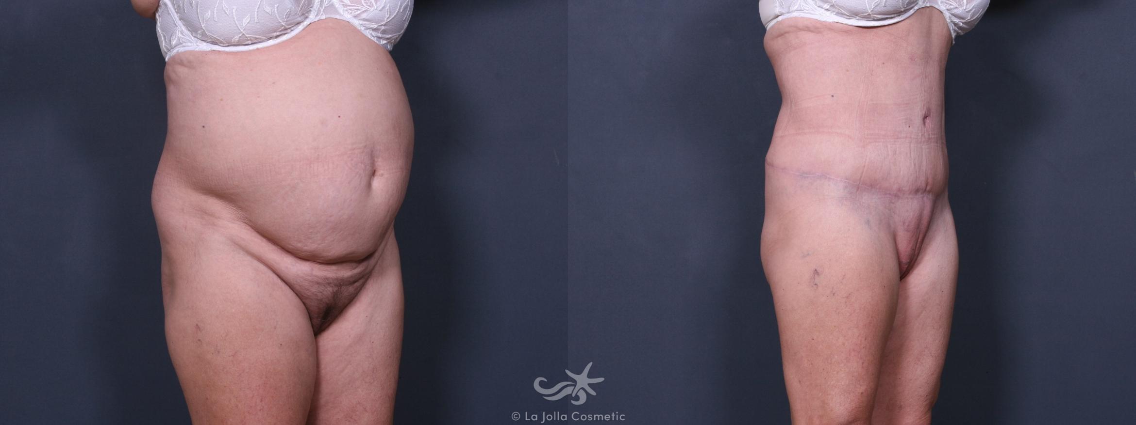 Before & After Tummy Tuck Result 238 Right Oblique View in San Diego, CA