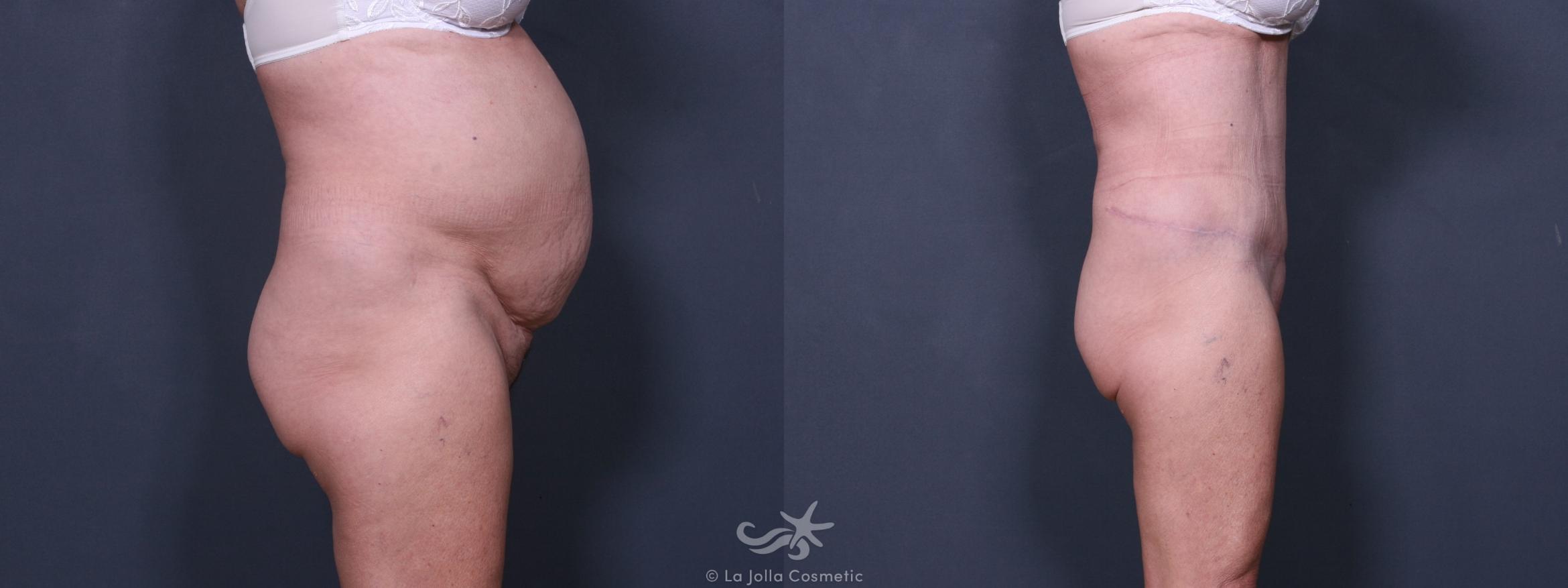 Before & After Tummy Tuck Result 238 Right Side View in San Diego, CA