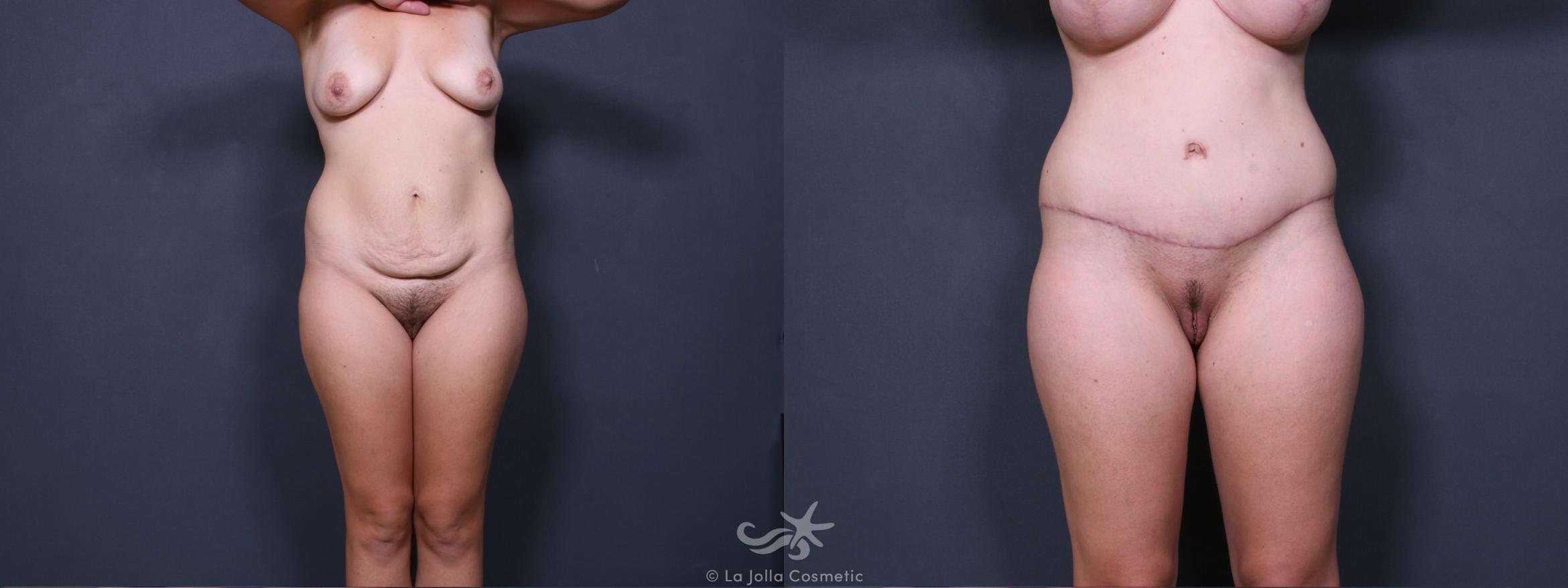Before & After Tummy Tuck Result 277 Front View in San Diego, CA