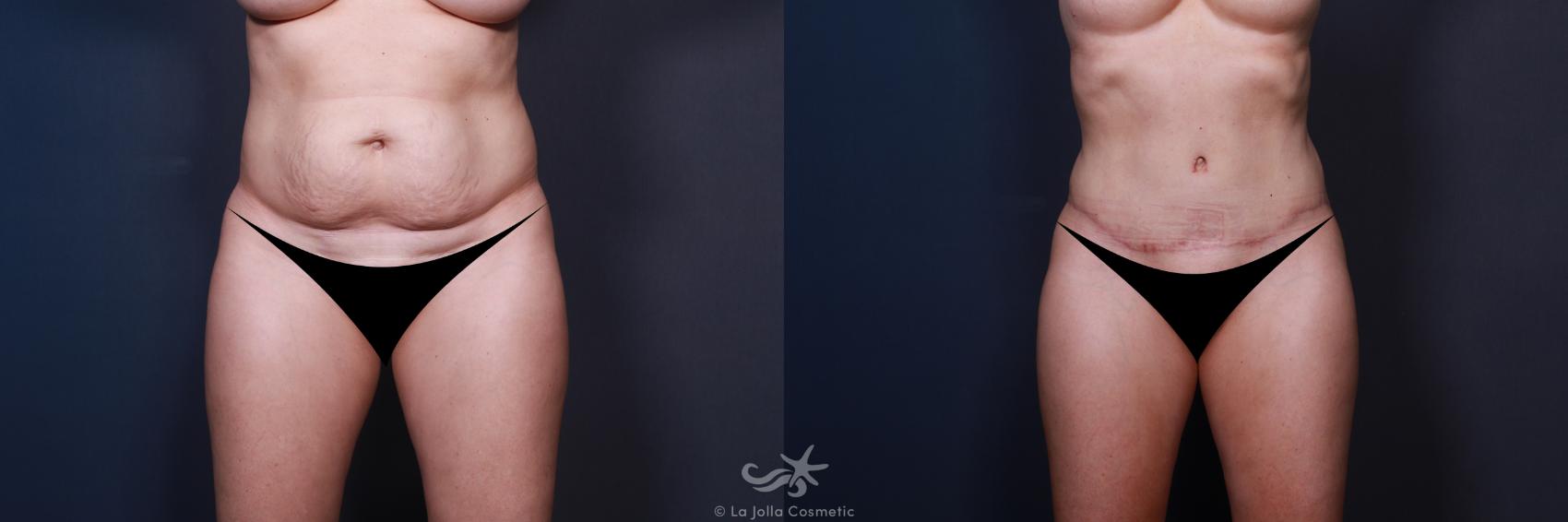 Before & After Tummy Tuck Result 28 Front View in San Diego, CA