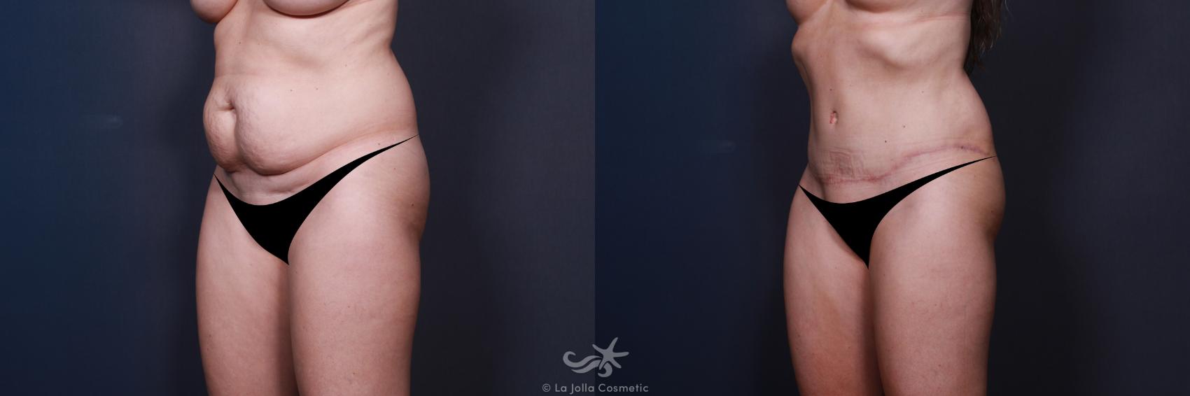 Before & After Tummy Tuck Result 28 Left Oblique View in San Diego, CA