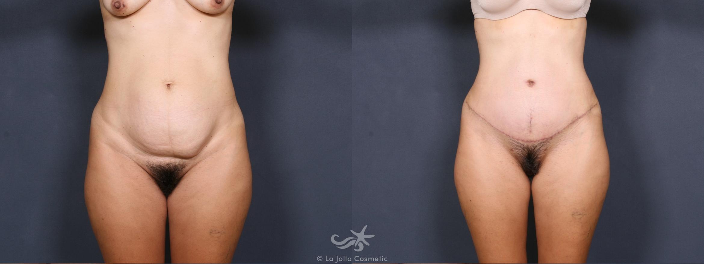 Before & After Tummy Tuck Result 287 Front View in San Diego, CA