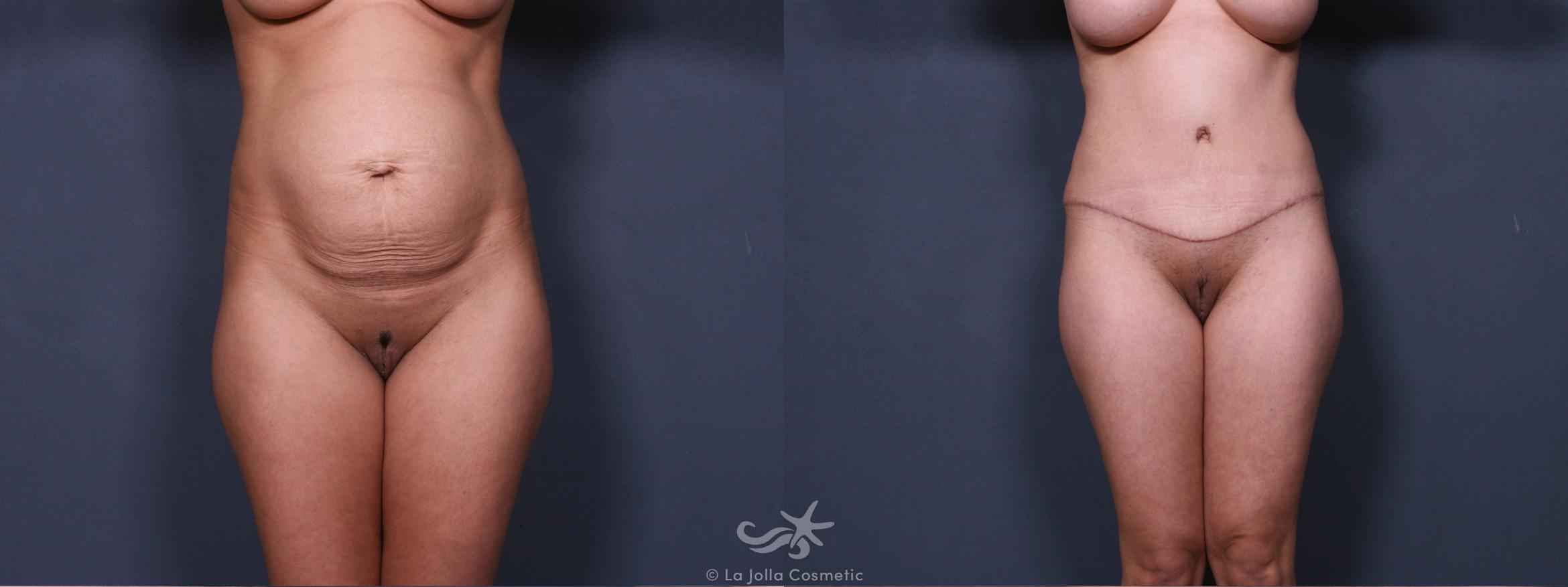 Before & After Tummy Tuck Result 289 Front View in San Diego, CA