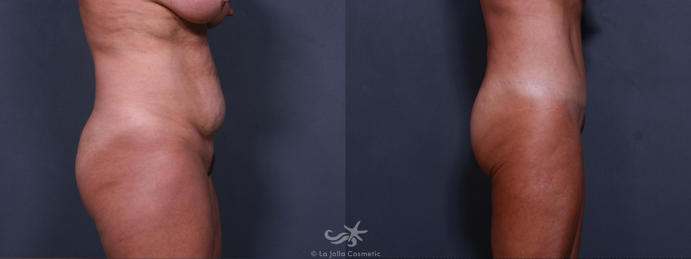 Before & After Tummy Tuck Result 307 Right Side View in San Diego, CA
