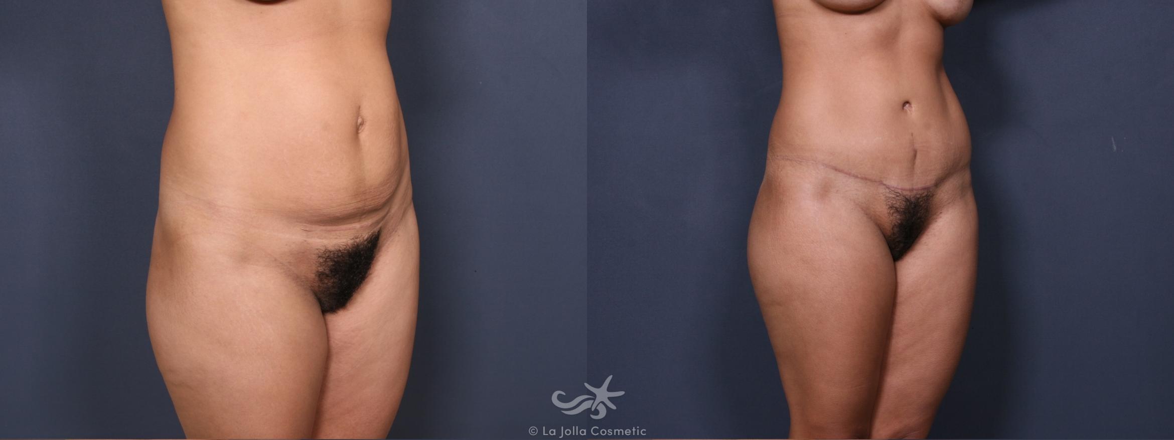 Before & After Tummy Tuck Result 318 Right Oblique View in San Diego, CA