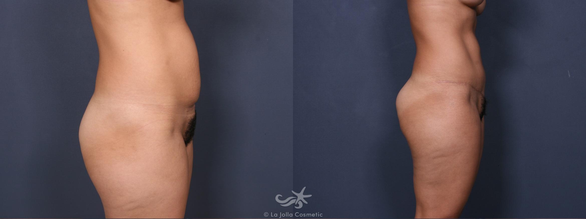Before & After Tummy Tuck Result 318 Right Side View in San Diego, CA
