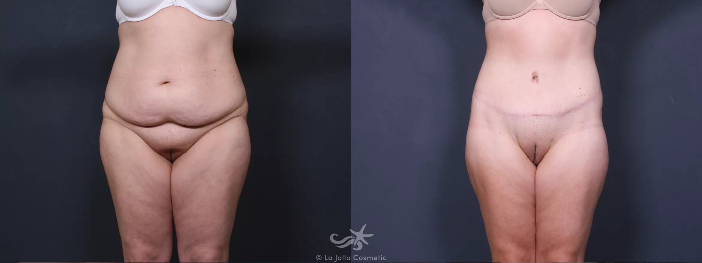 Before & After Tummy Tuck Result 407 Front View in San Diego, CA