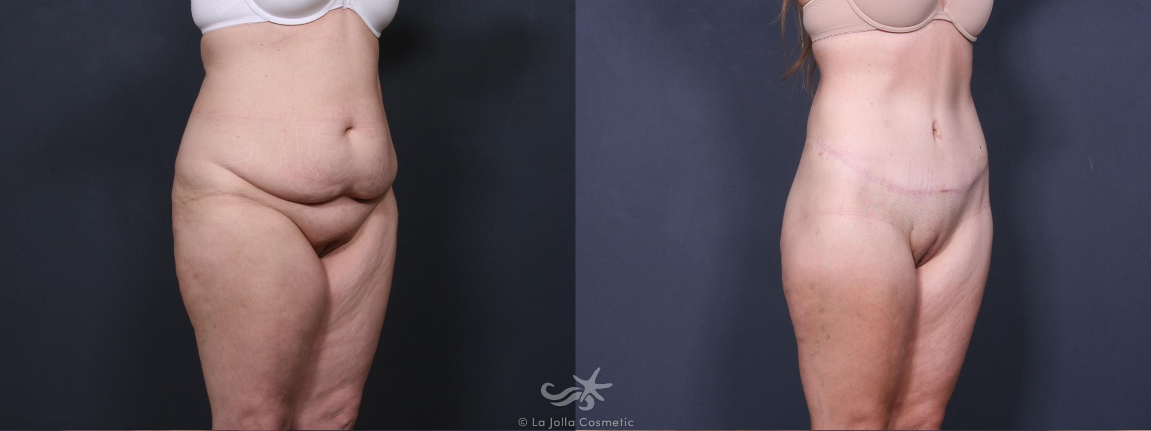 Before & After Tummy Tuck Result 407 Right Oblique View in San Diego, CA