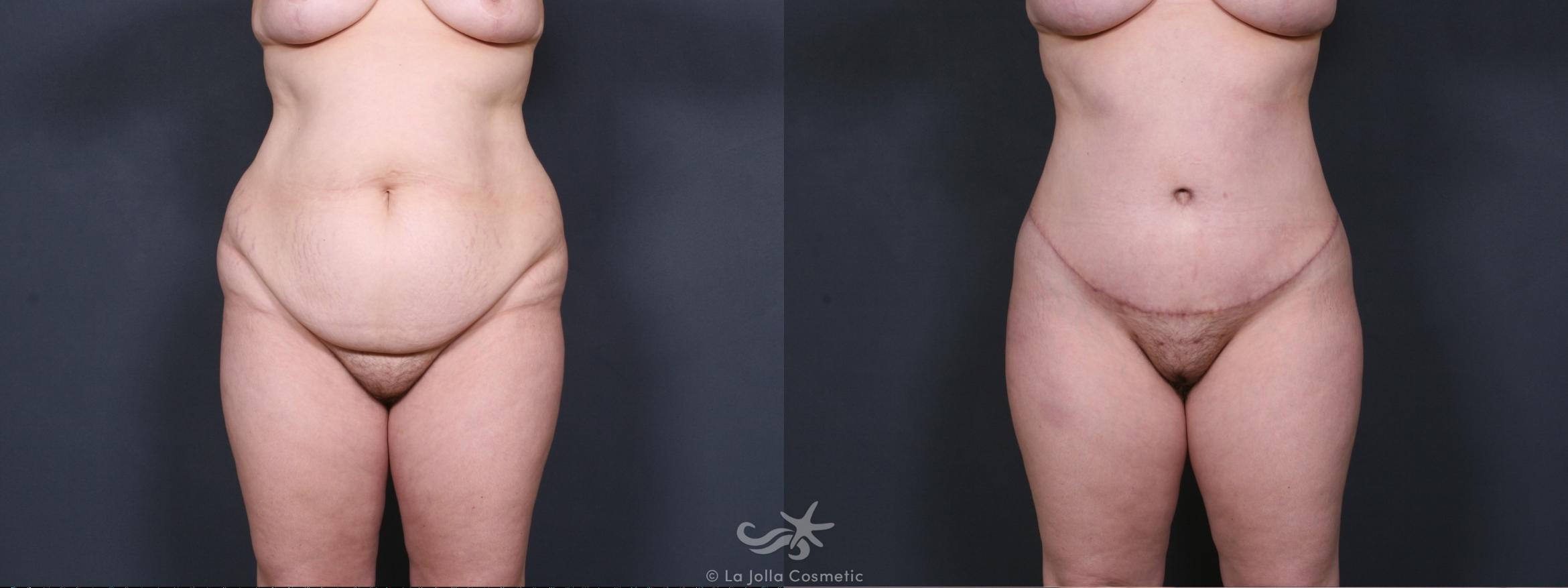 Before & After Tummy Tuck Result 444 Front View in San Diego, CA