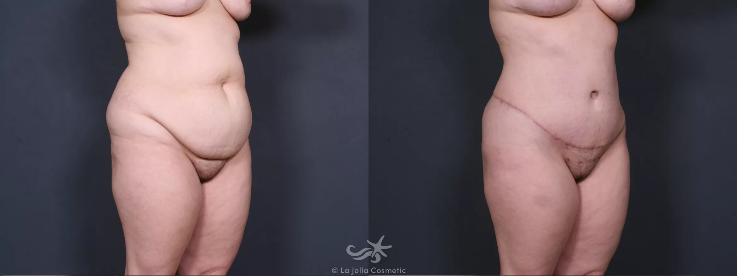 Before & After Tummy Tuck Result 444 Right Oblique View in San Diego, CA