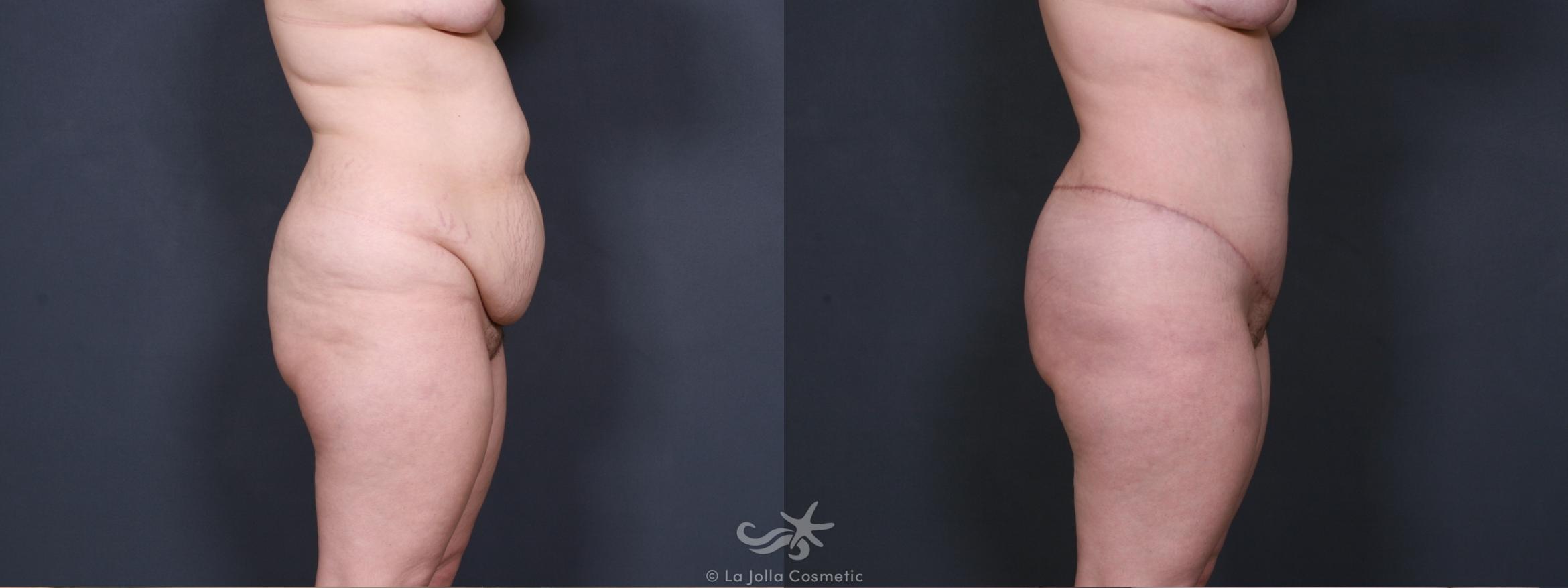 Before & After Tummy Tuck Result 444 Right Side View in San Diego, CA