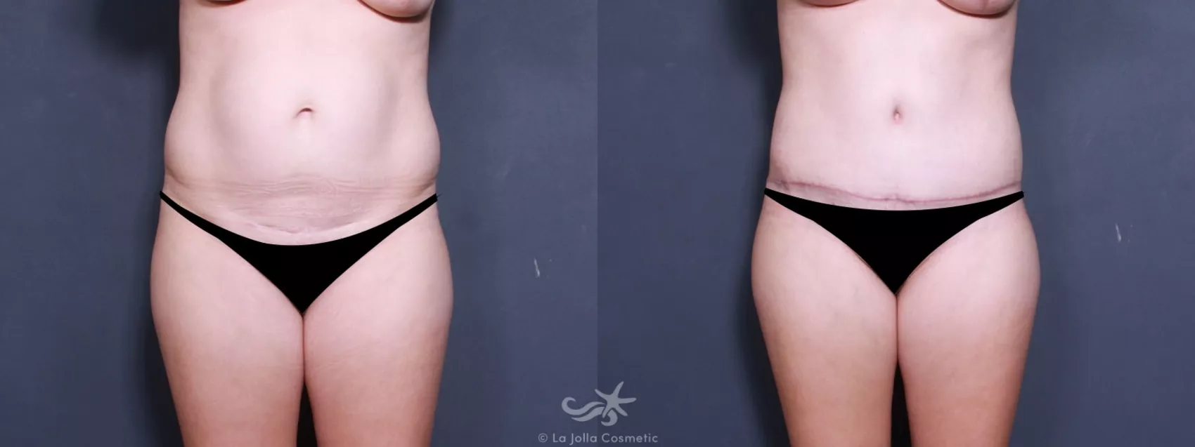 Before & After Tummy Tuck Result 507 Front View in San Diego, CA