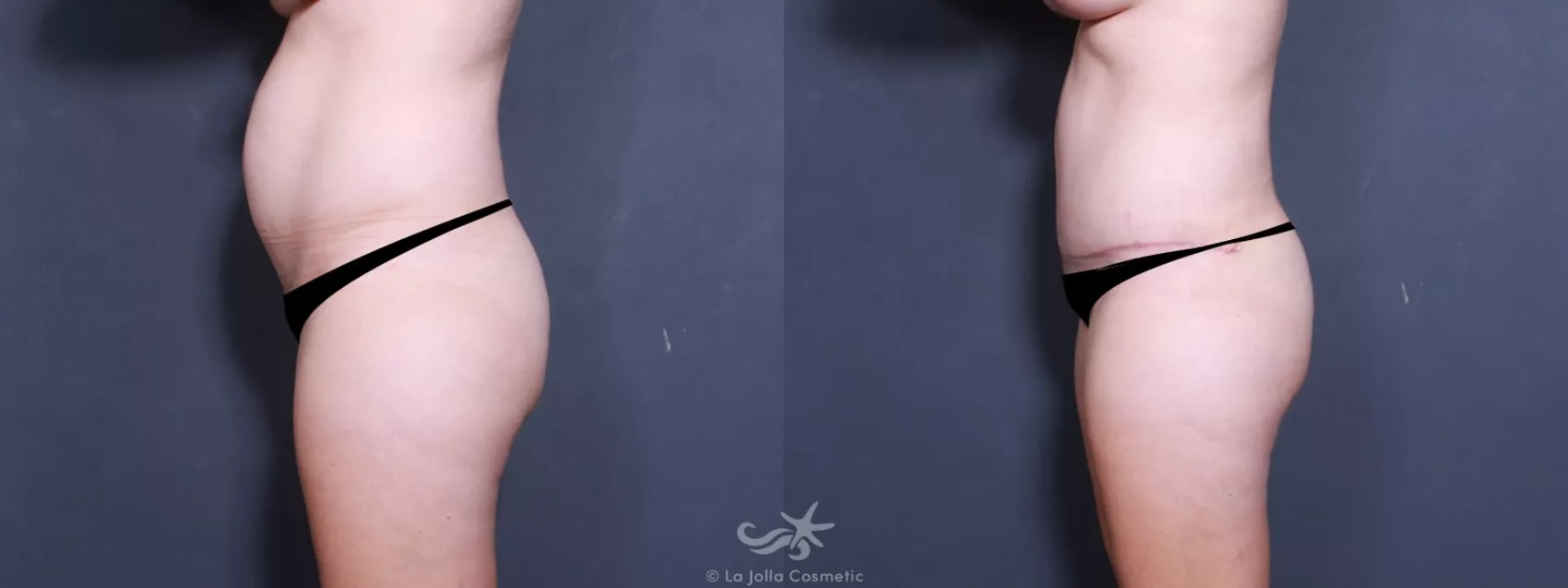 Before & After Tummy Tuck Result 507 Left Side View in San Diego, CA