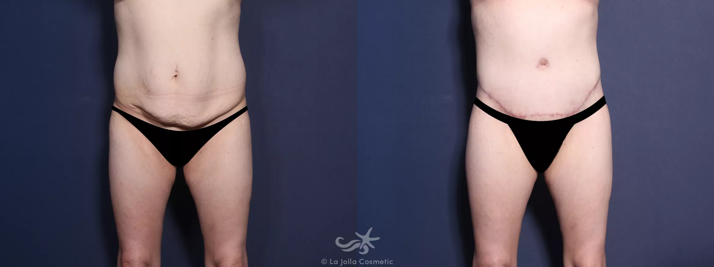 Before & After Tummy Tuck Result 548 Front View in San Diego, CA