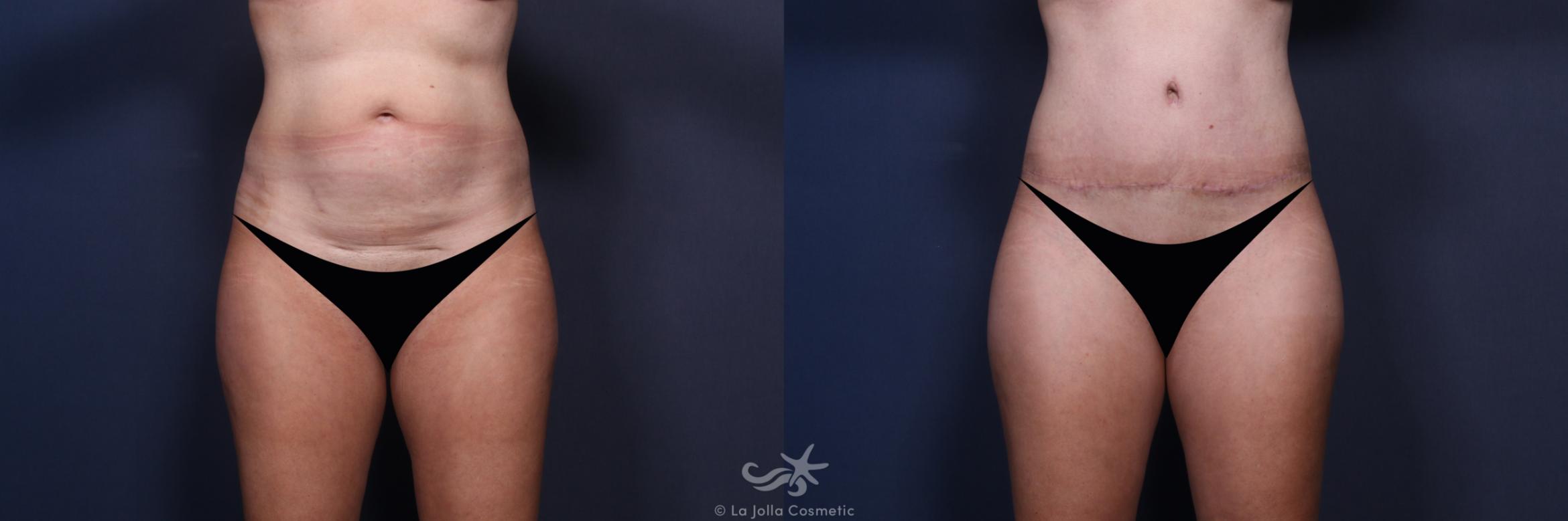 Before & After Tummy Tuck Result 550 Front View in San Diego, CA