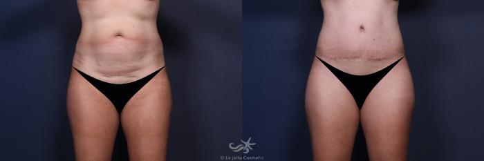 Before & After Tummy Tuck Result 550 Front View in San Diego, Carlsbad, CA