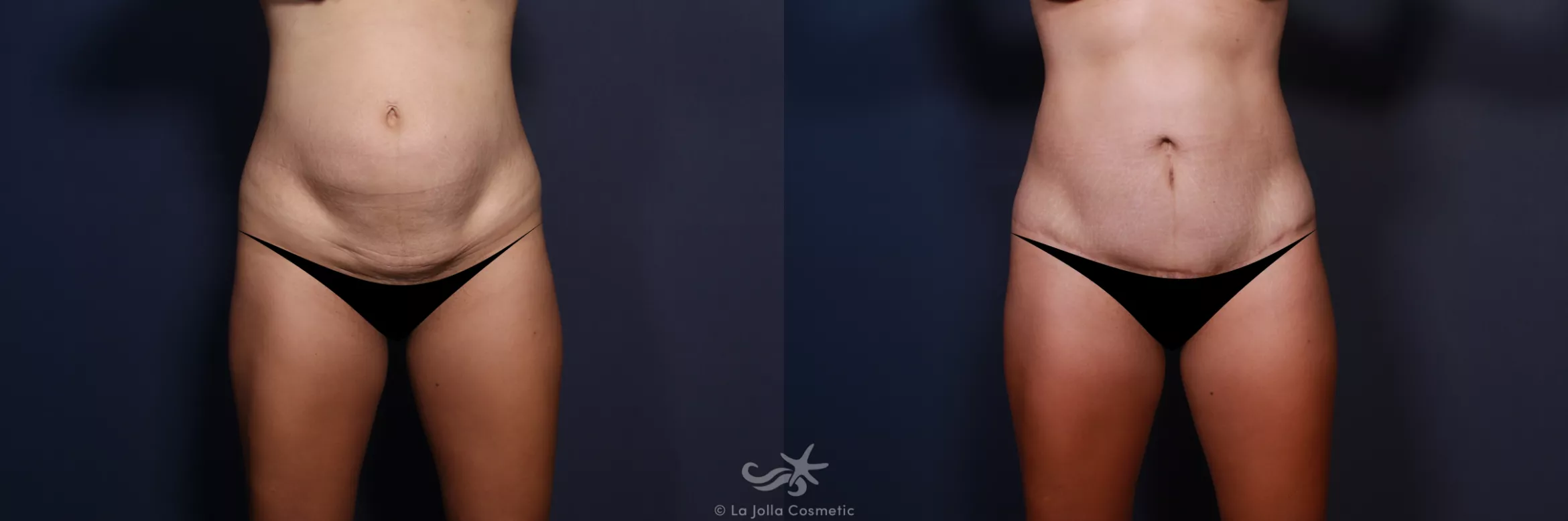 Before & After Tummy Tuck Result 551 Front View in San Diego, CA