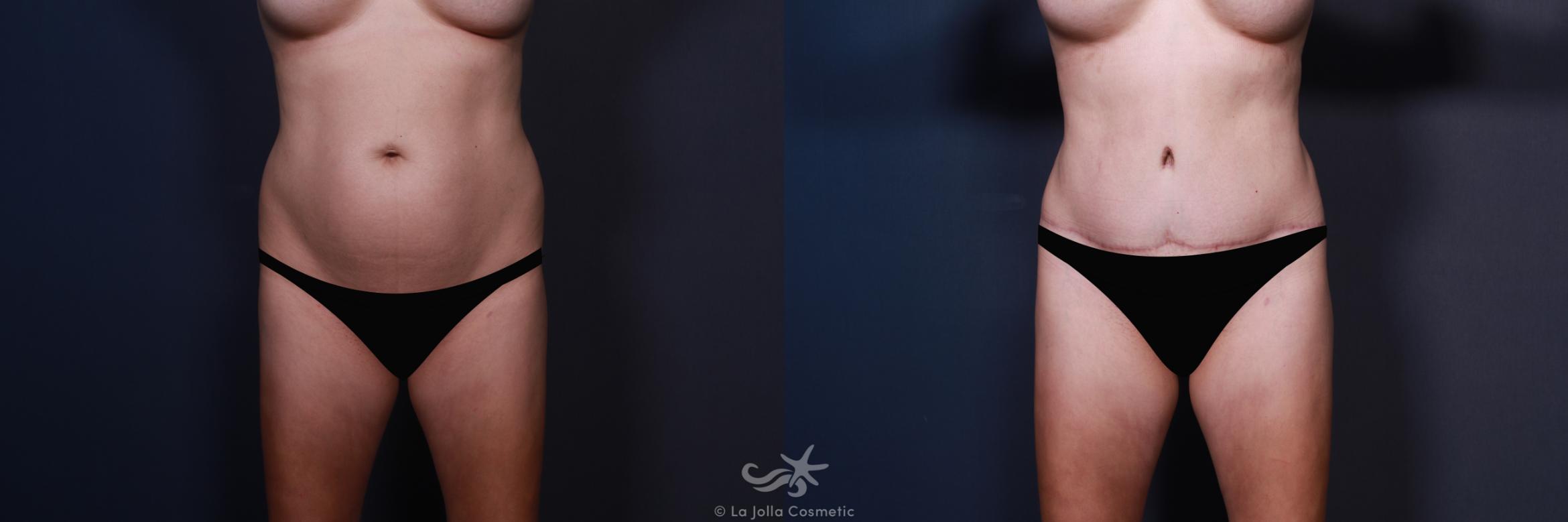 Before & After Liposuction Result 562 Front View in San Diego, CA