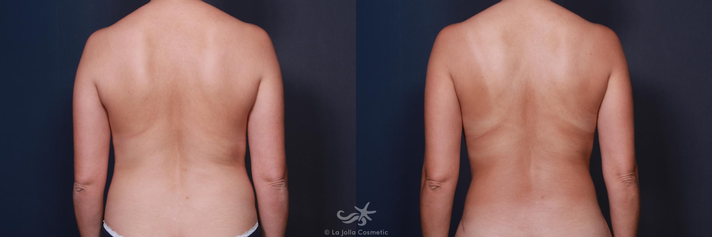 Before & After Tummy Tuck Result 571 Back View in San Diego, CA