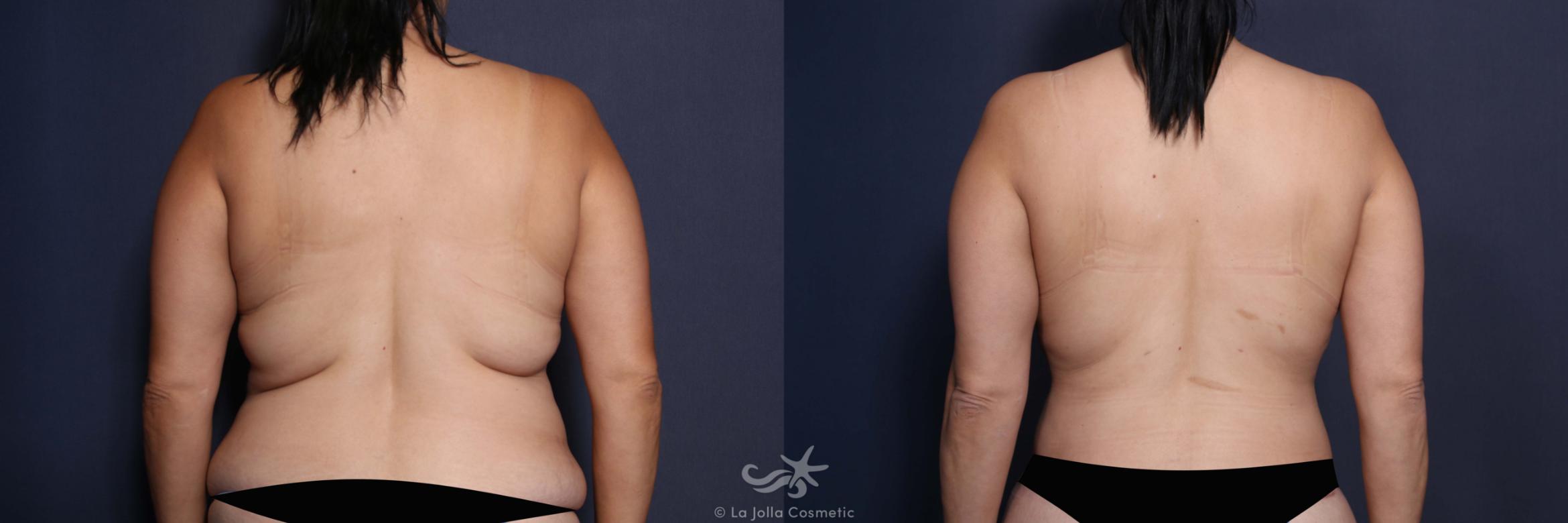 Before & After Tummy Tuck Result 574 Back View in San Diego, CA