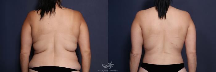 Before & After Tummy Tuck Result 574 Back View in San Diego, Carlsbad, CA