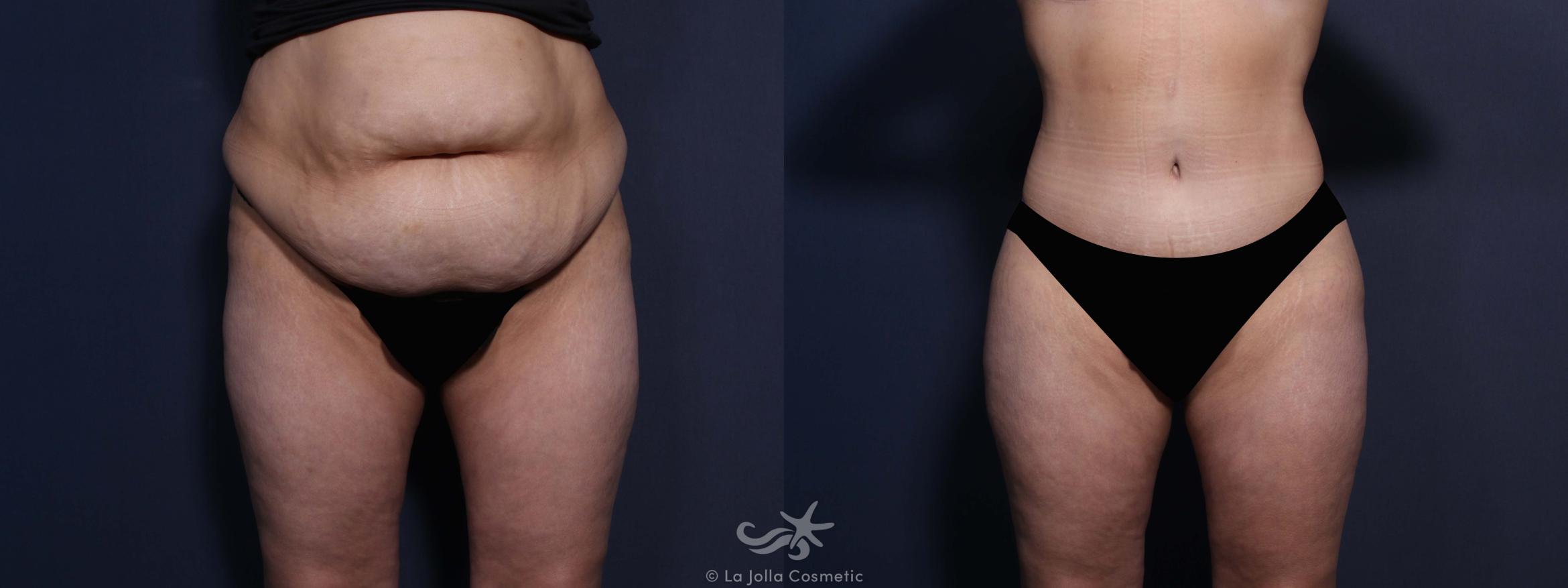 Before & After Tummy Tuck Result 574 Front View in San Diego, CA
