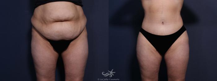 Before & After Tummy Tuck Result 574 Front View in San Diego, Carlsbad, CA