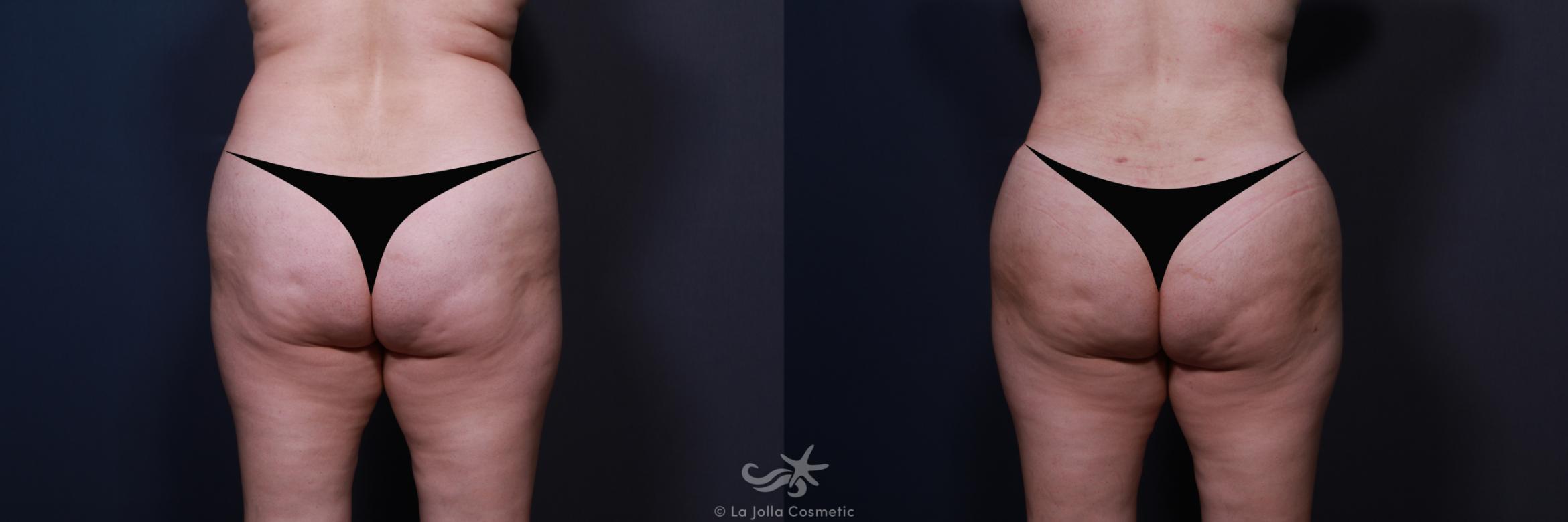 Before & After Tummy Tuck Result 579 Back BBL View in San Diego, CA