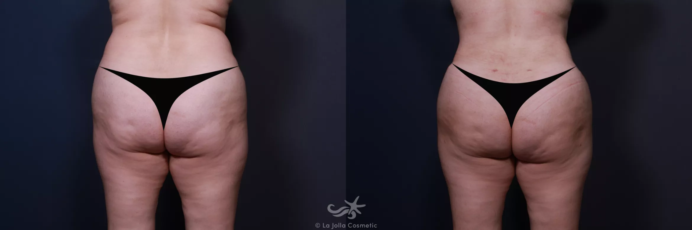 Before & After Tummy Tuck Result 579 Back BBL View in San Diego, CA