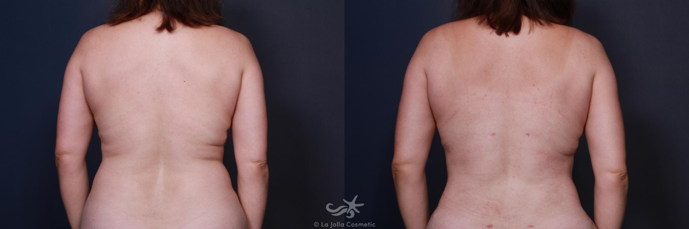Before & After Tummy Tuck Result 579 Back View in San Diego, CA
