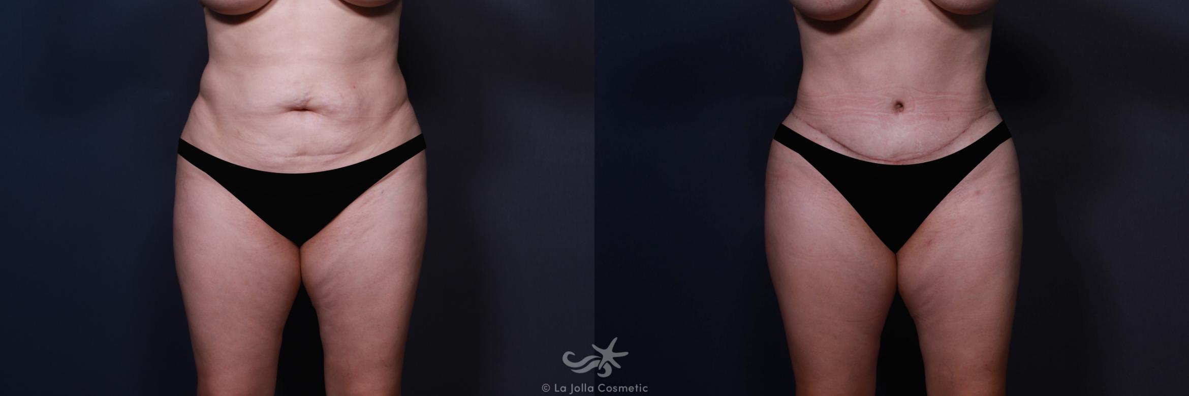 Before & After Tummy Tuck Result 579 Front View in San Diego, CA