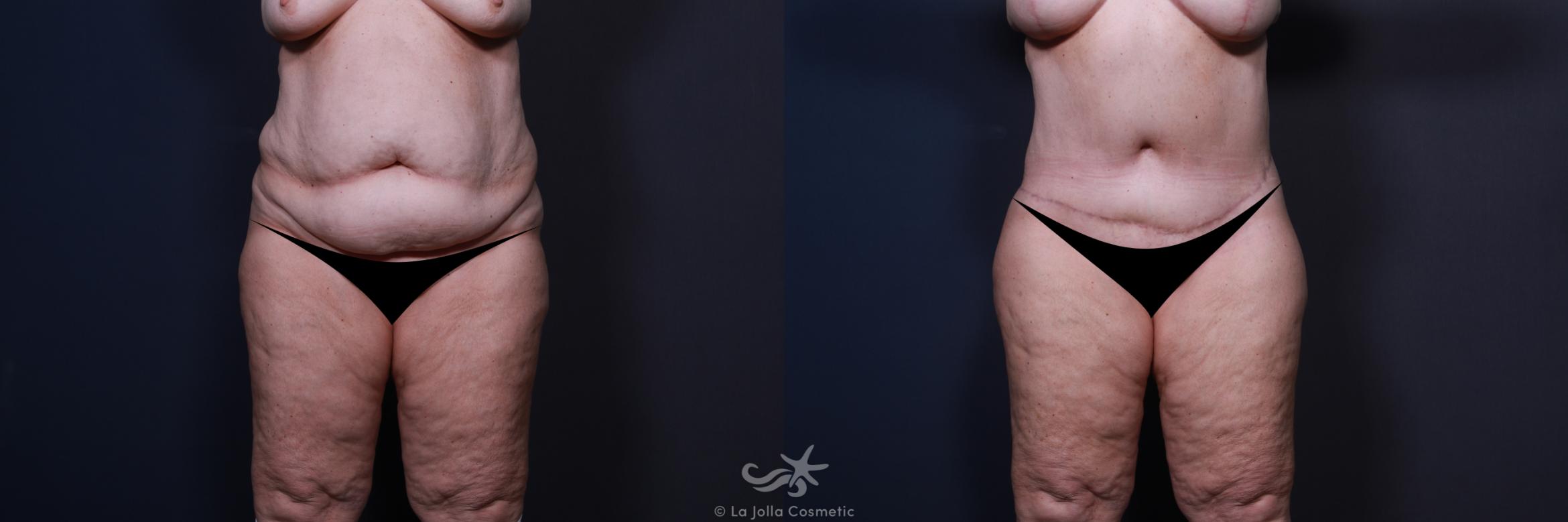 Before & After Tummy Tuck Result 6 Front View in San Diego, CA