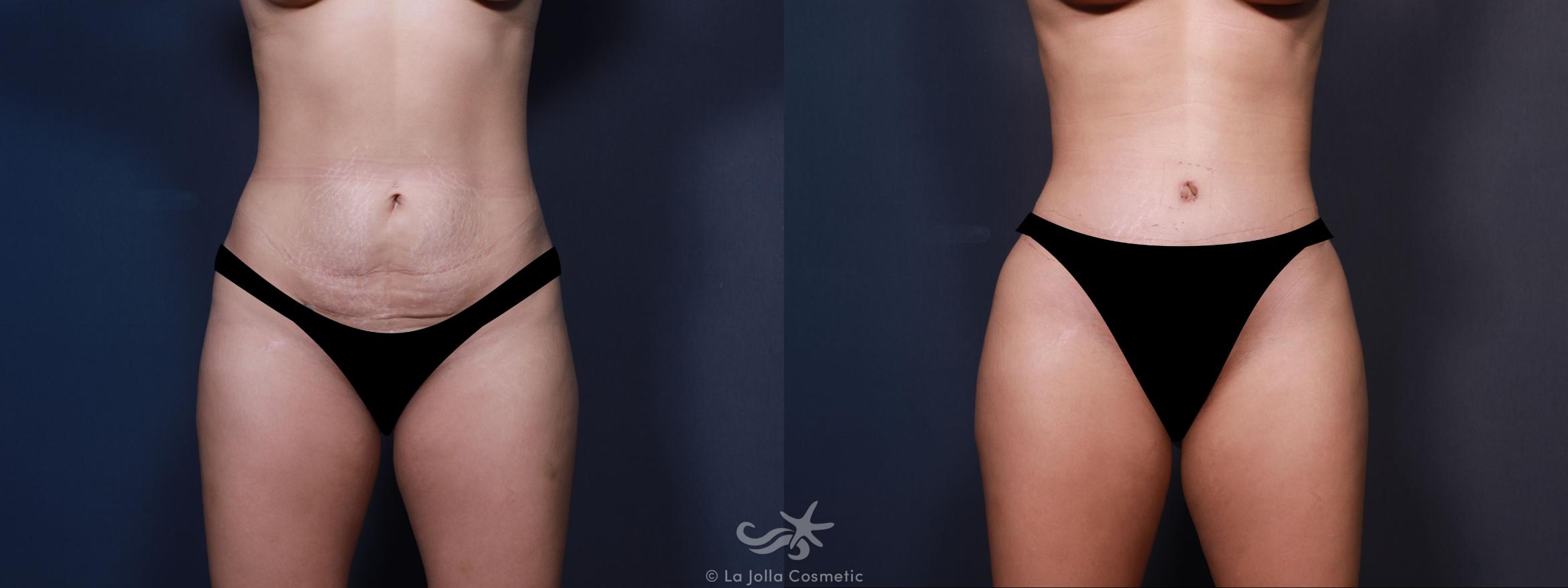 Before & After Tummy Tuck Result 607 Front View in San Diego, CA