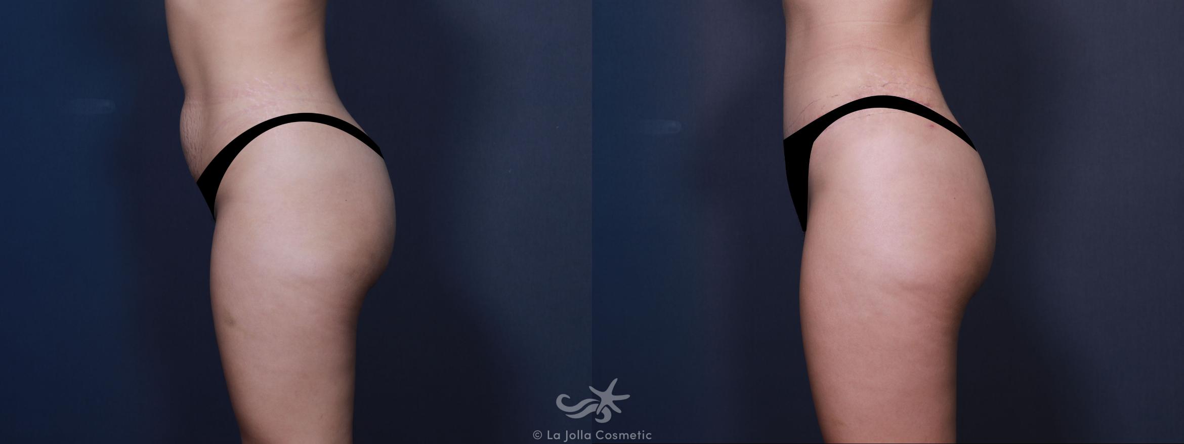 Before & After Tummy Tuck Result 607 Left Side View in San Diego, CA