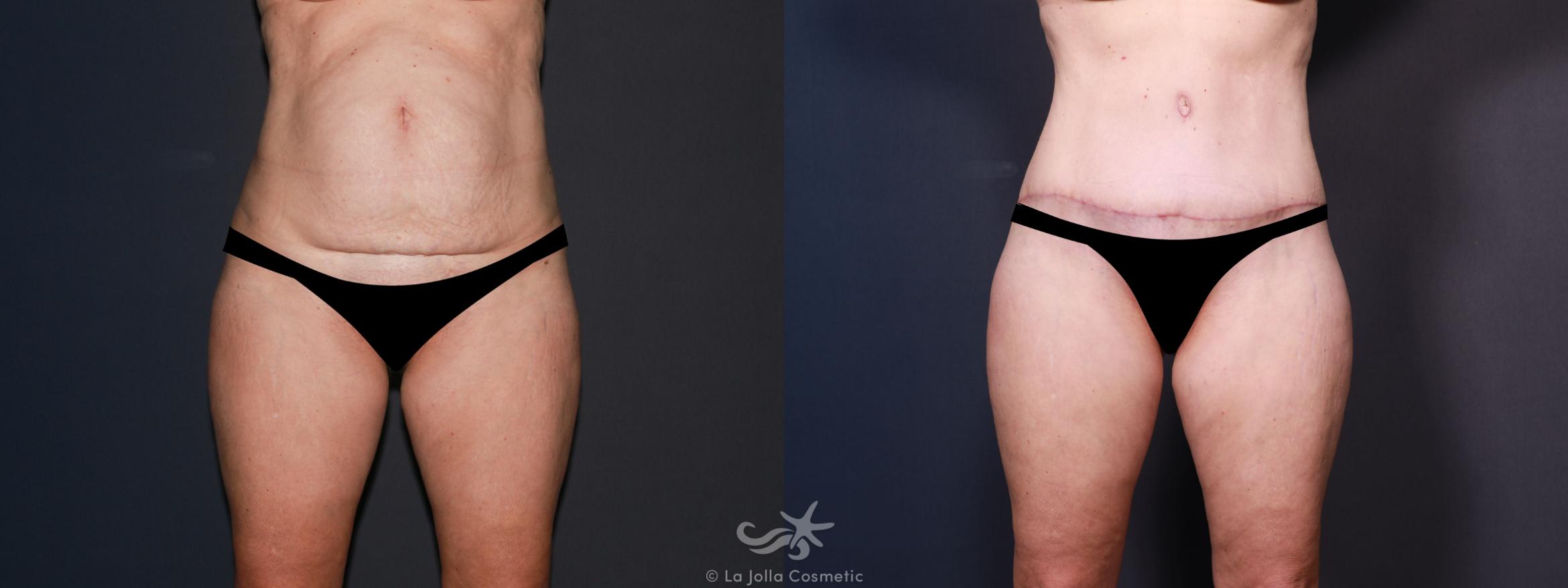 Before & After Tummy Tuck Result 635 Front View in San Diego, CA