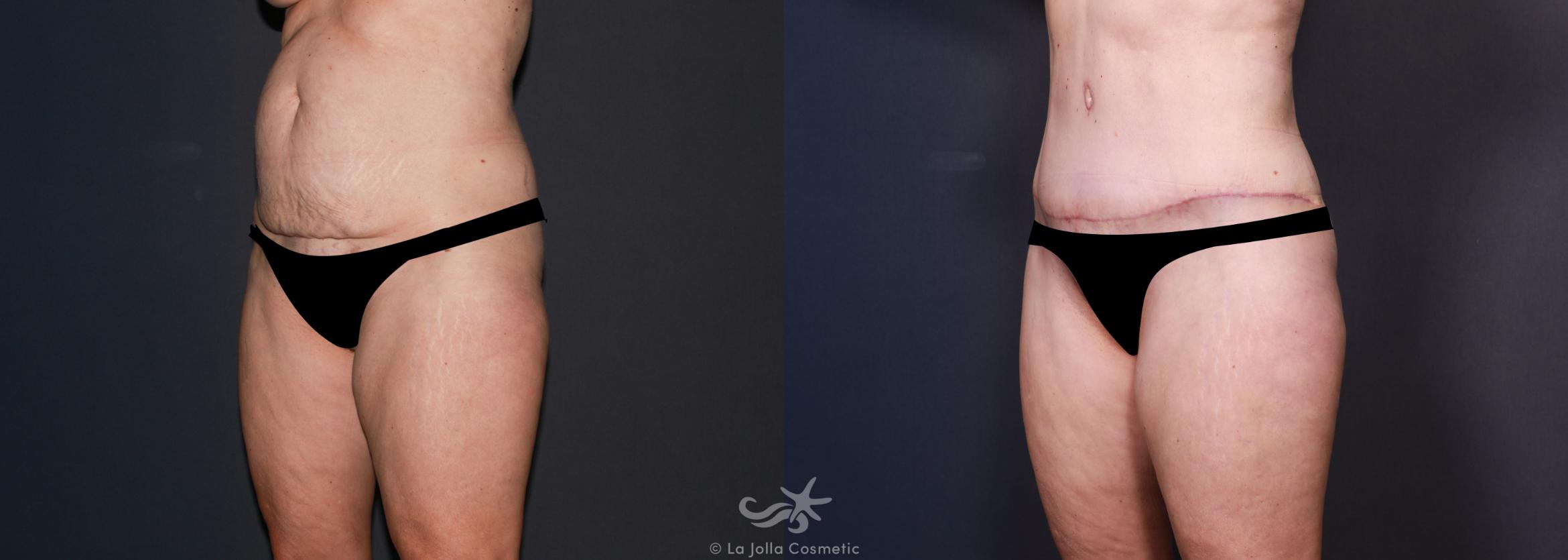 Before & After Tummy Tuck Result 635 Left Oblique View in San Diego, CA